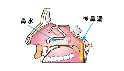 嗅覚障害　イラスト