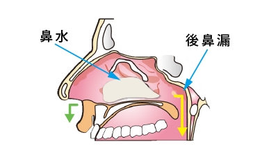 嗅覚障害　イラスト