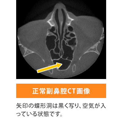 嗅覚障害　正常画像